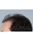 Before Hair Transplant&nbsp;Front